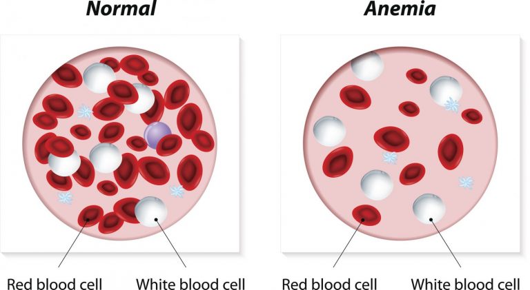 Srovnání bílých a červených krvinek – normální stav versus chudokrevnost