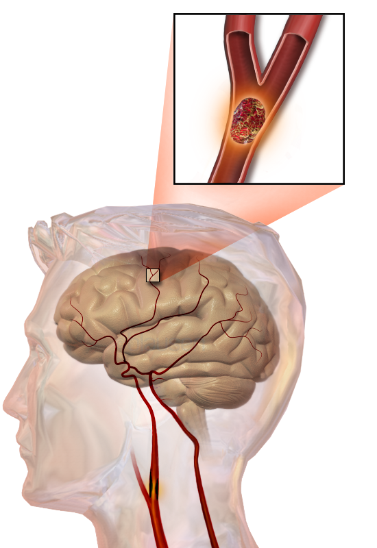 Znázornění Ischemické cévní mozkové příhody (viz tromb)
